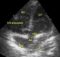 Perimembranous ventricular septal defect (VSD)