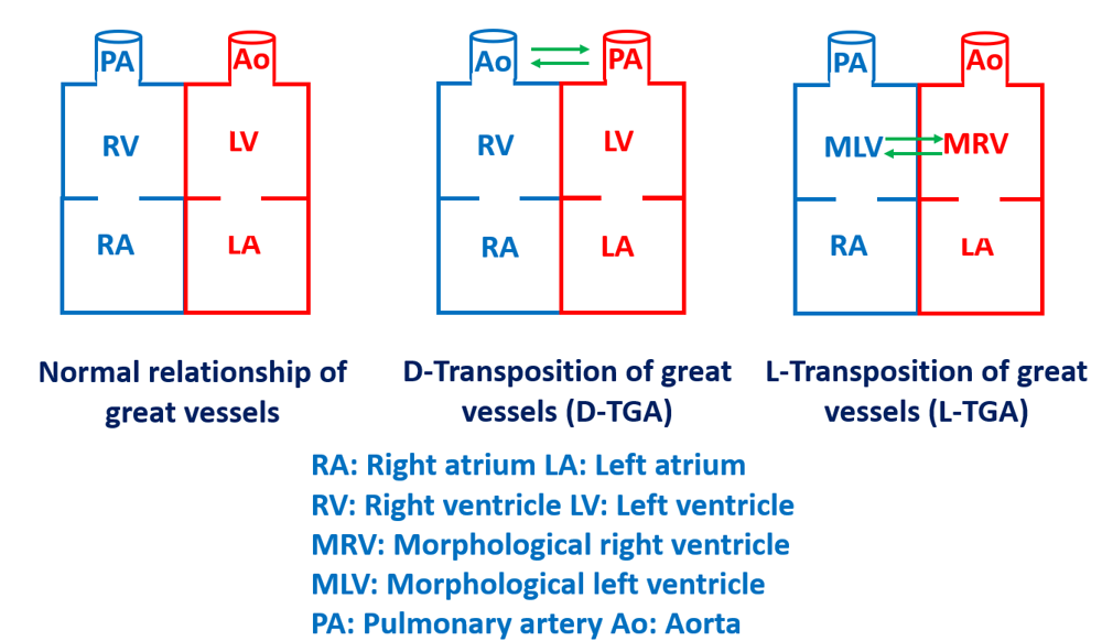Transposition of great vessels