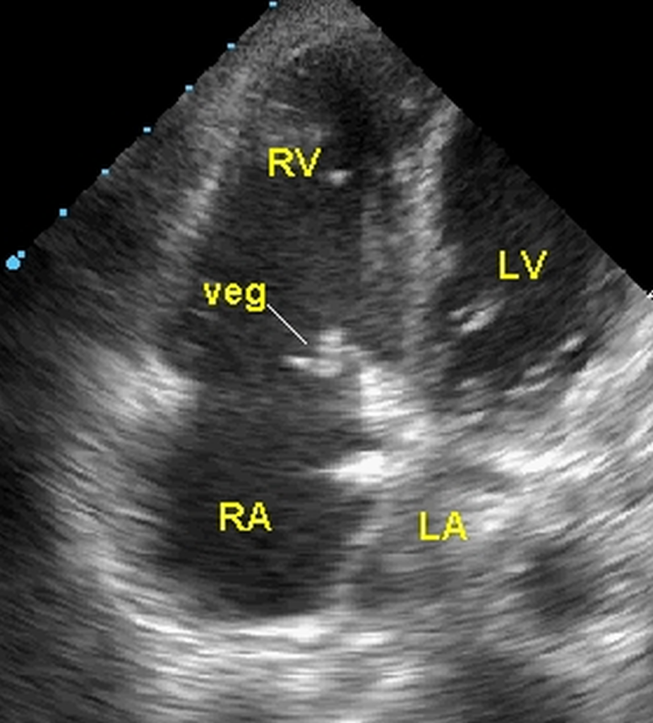 Vegetation on tricuspid valve – echocardiographic image
