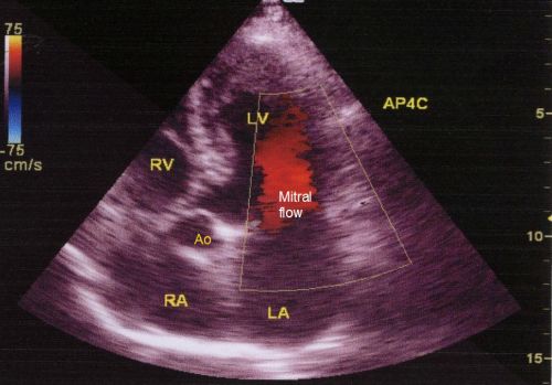 Apical five chamber view in echocardiography