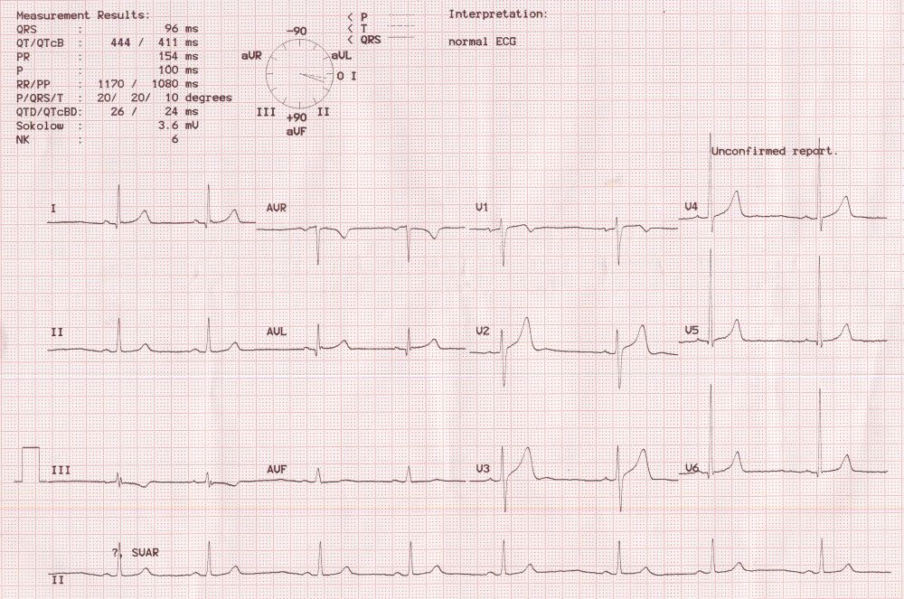 Determination of QRS axis