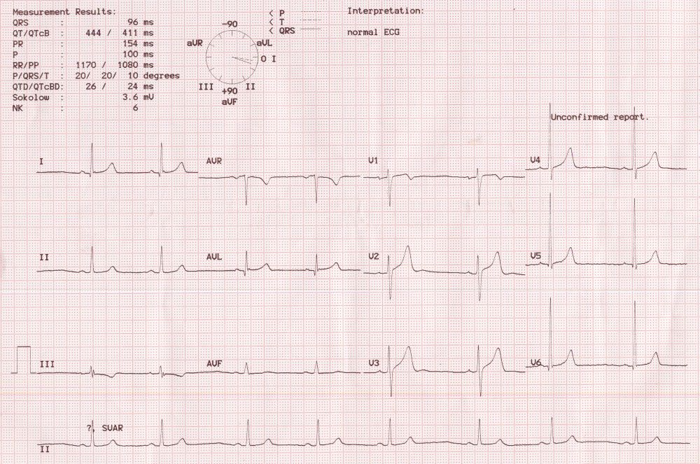 determination-of-qrs-axis-all-about-cardiovascular-system-and-disorders