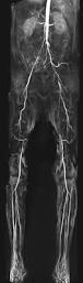 MR angio of aortic bifurcation and lower limb arteries