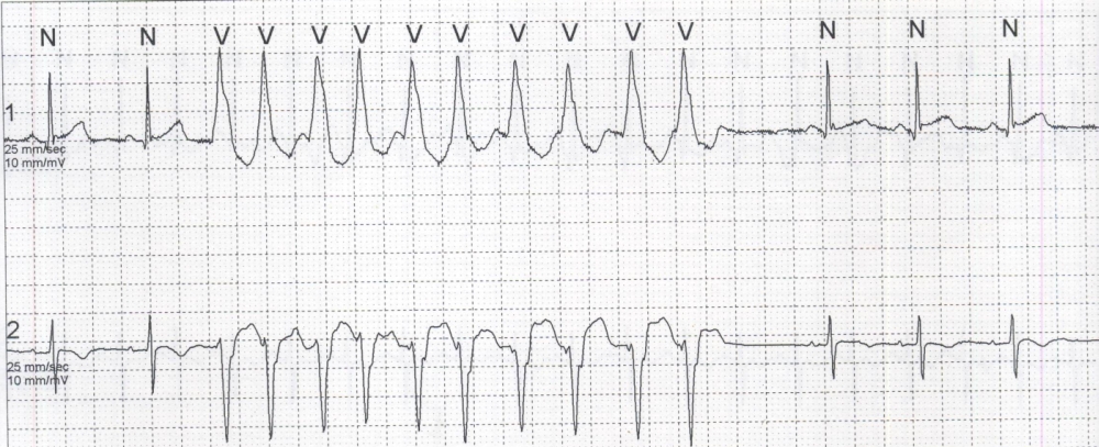 Wide QRS tachycardia on Holter