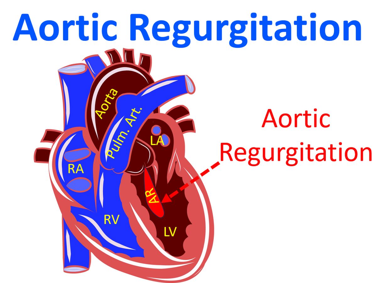 Aortic Regurgitation All About Cardiovascular System And Disorders