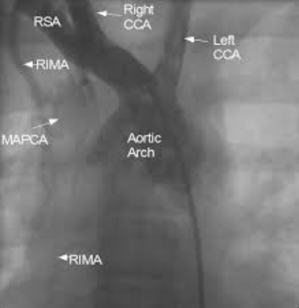 MAPCA from right internal mammary artery