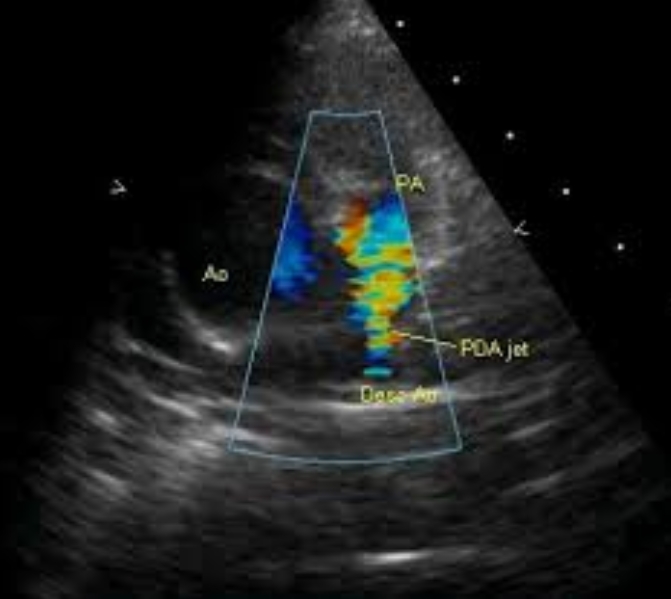 Patent ductus arteriosus jet in Tetralogy of Fallot on Colour Doppler imaging