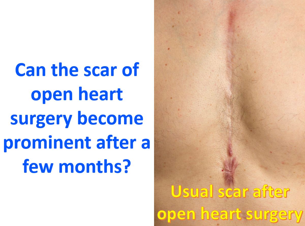 Can the scar of open heart surgery become prominent after a few months