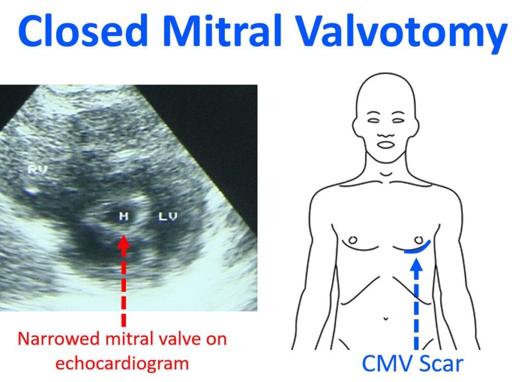 Valvotomy Instrument Closed heart surgery for mitral stenosis (closed mitral valvotomy ...