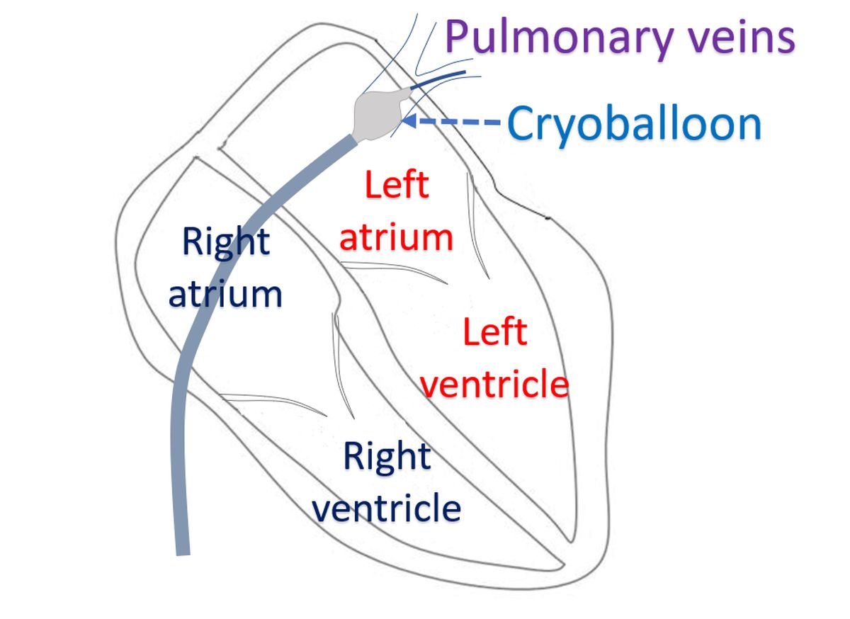 Cryoballoon pulmonary vein