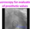 Fluoroscopy for evaluation of prosthetic valves