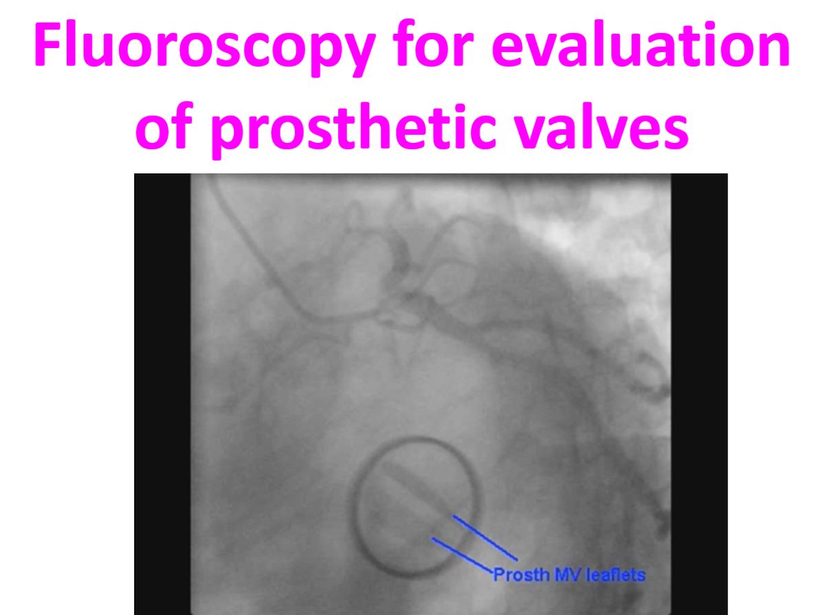 Fluoroscopy for evaluation of prosthetic valves