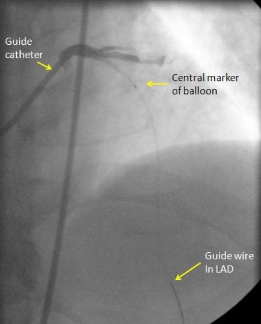 Guide wire and deflated angioplasty balloon in coronary artery