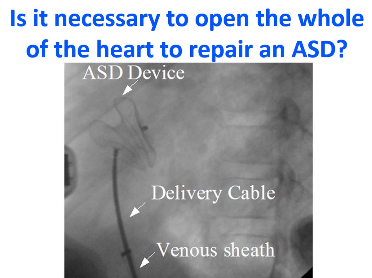 Is it necessary to open the whole of the heart to repair an ASD