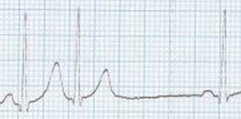 supraventricular-ectopics