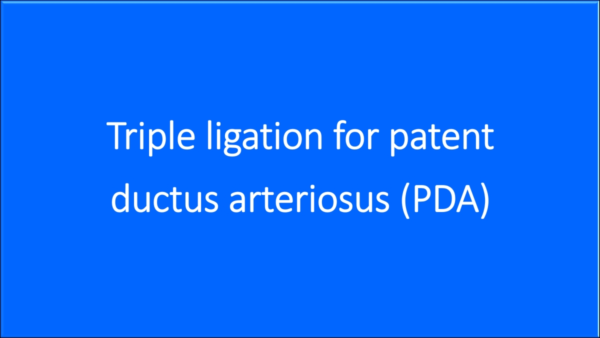 Triple ligation for patent ductus arteriosus (PDA)