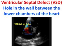 Ventricular Septal Defect (VSD) Hole in the wall between the lower chambers of the heart