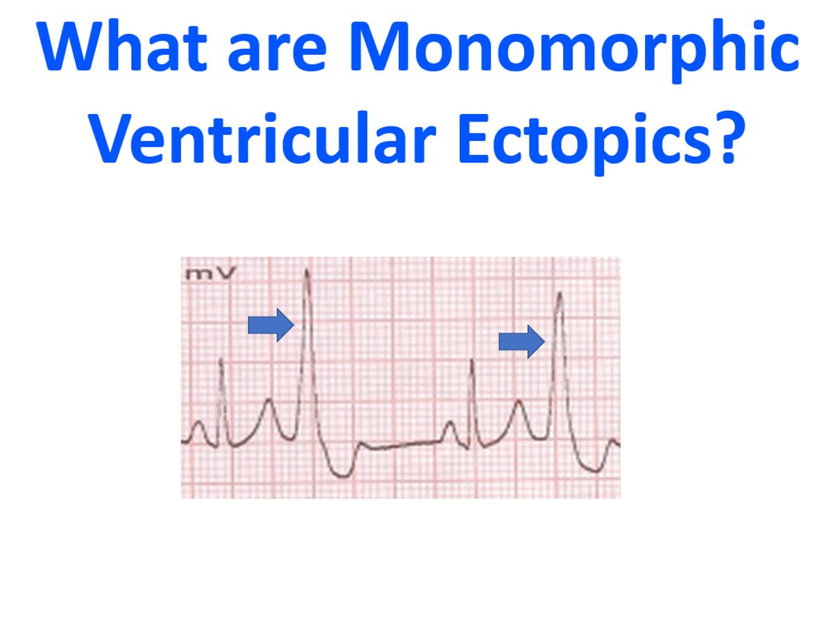What are Monomorphic Ventricular Ectopics