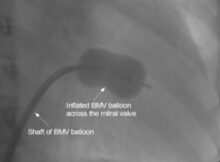 BMV - inflation of balloon across mitral valve