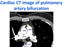 Cardiac CT image of pulmonary artery bifurcation