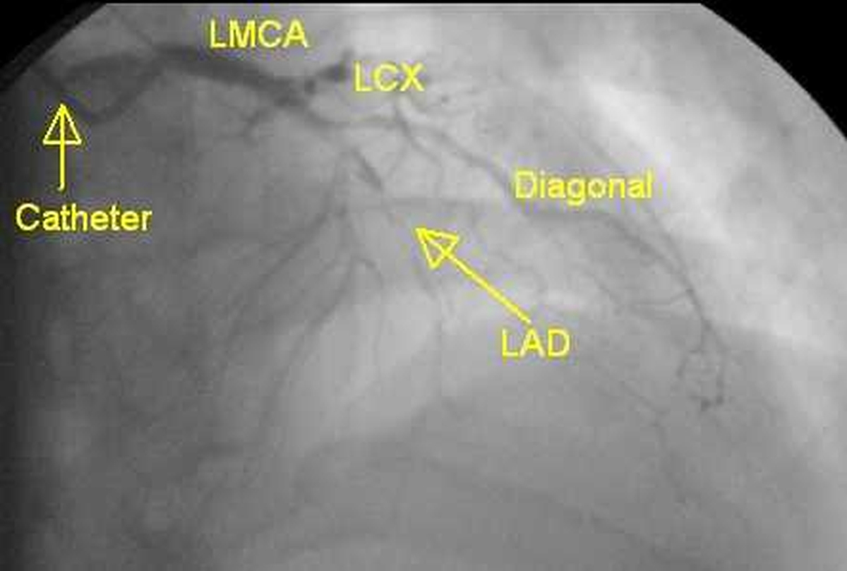 LAD total occlusion