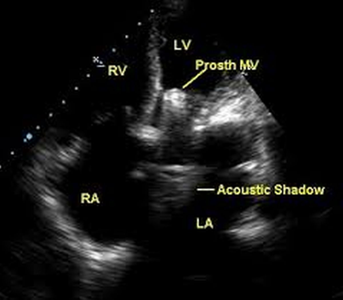 Prosthetic mitral valve in apical four chamber view