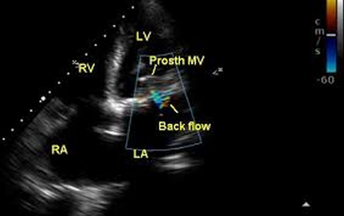 Prosthetic mitral valve in apical four chamber view with colour flow mapping