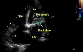 Echocardiographic profile of prosthetic mitral valve