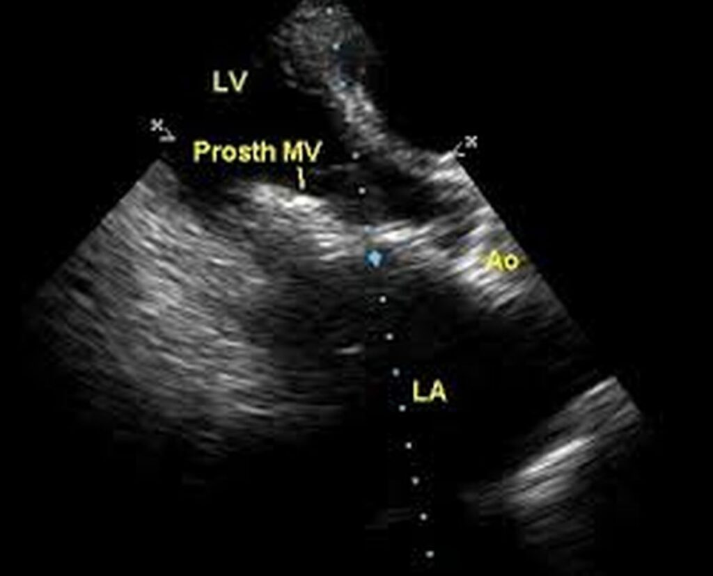 Prosthetic mitral valve echocardiogram