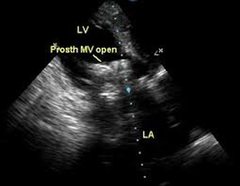 Prosthetic mitral valve echocardiogram