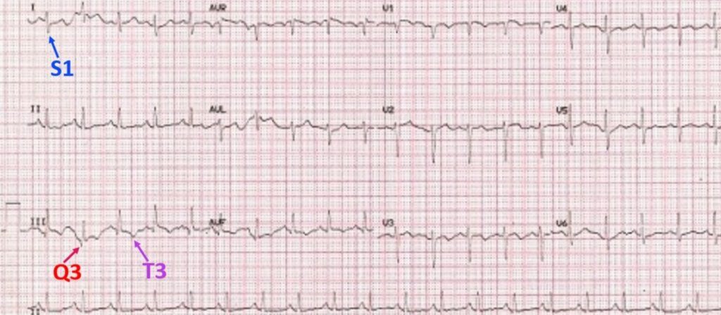 S1Q3T3 pattern on ECG in pulmonary embolism – All About Cardiovascular ...