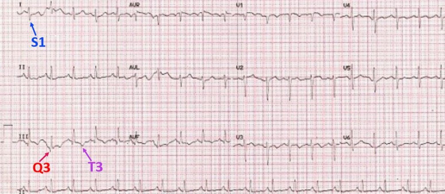 S1Q3T3 pattern on ECG in pulmonary embolism All About Cardiovascular