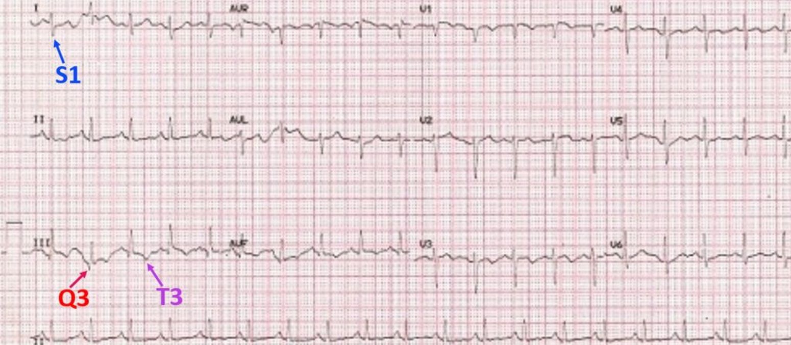 Pulmonary Embolism Ecg Changes HBPB Pulmonary Embolism Ecg Changes HBPB