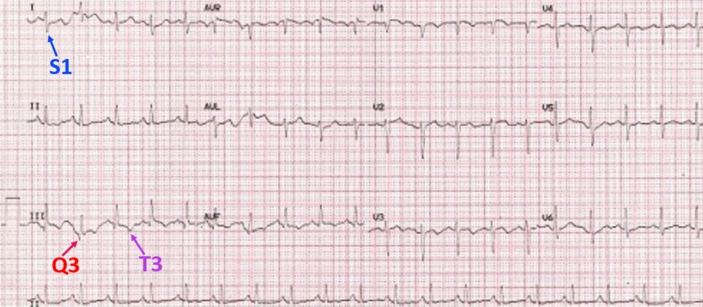 S1q3t3 Pattern On Ecg In Pulmonary Embolism