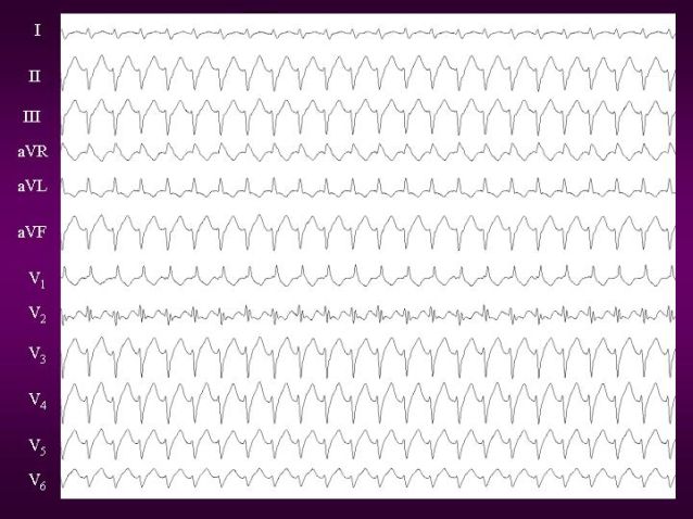 Posterior fascicular tachycardia