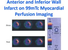 Anterior and Inferior Wall Infarct on 99mTc Myocardial Perfusion Imaging