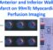 Anterior and Inferior Wall Infarct on 99mTc Myocardial Perfusion Imaging