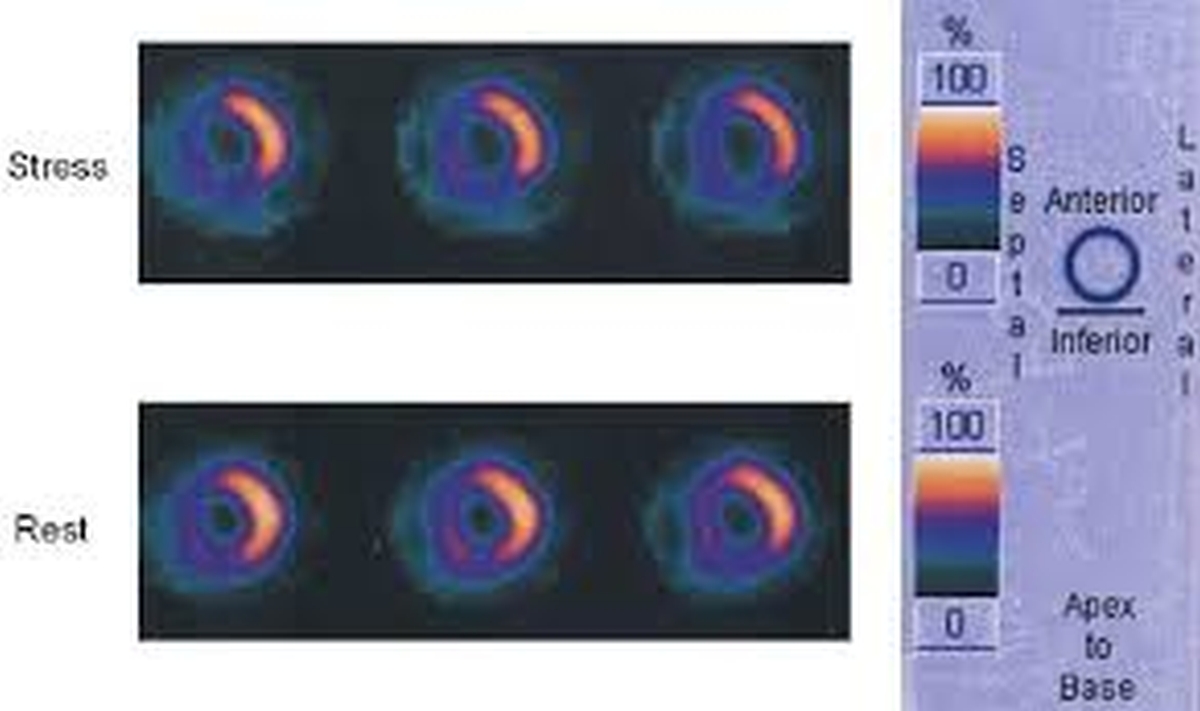 99mTc myocardial perfusion imaging