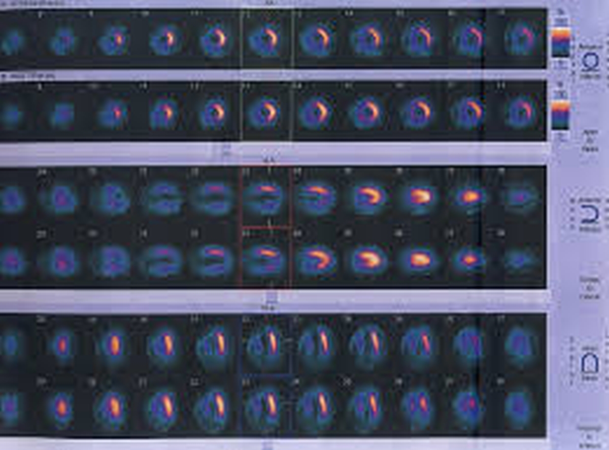 99mTc myocardial perfusion imaging