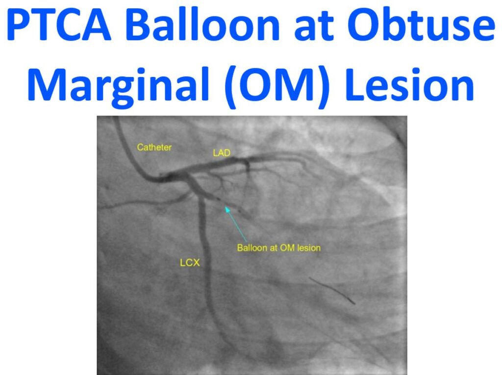 PTCA Balloon at Obtuse Marginal (OM) Lesion