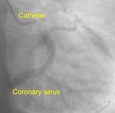 Coronary angiogram levophase