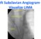 Left Subclavian Angiogram to Visualize LIMA