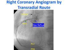 Right Coronary Angiogram by Transradial Route