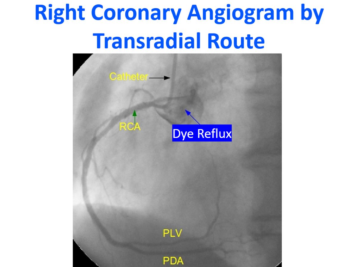 Right Coronary Angiogram by Transradial Route
