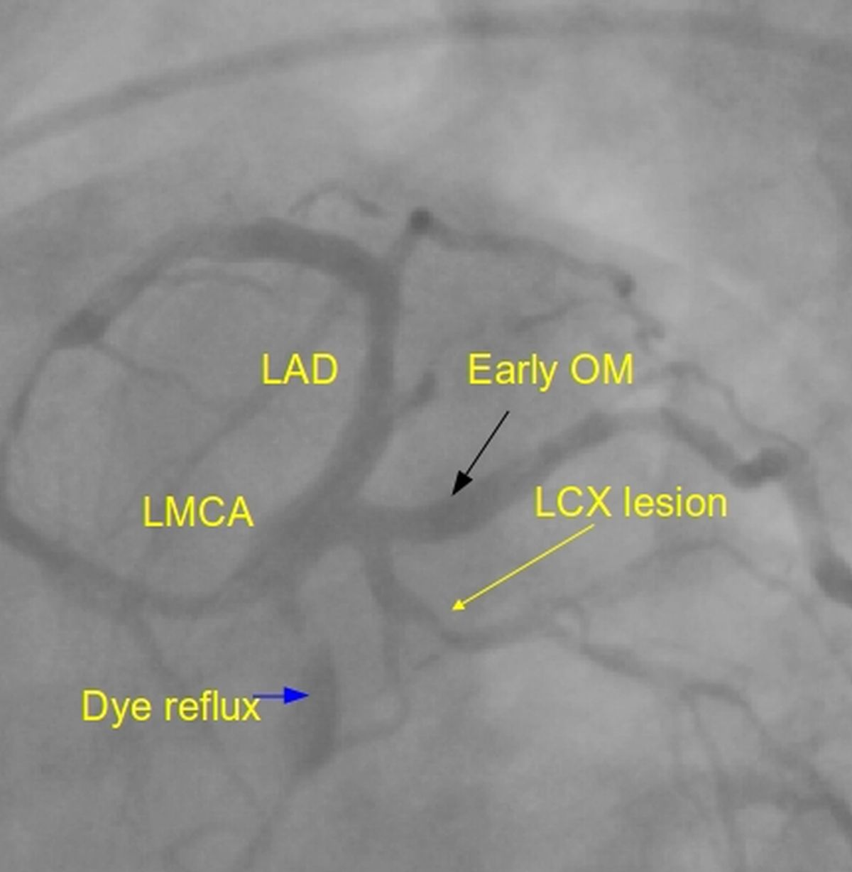 Spider view - LAO caudal view of left coronary angiogram