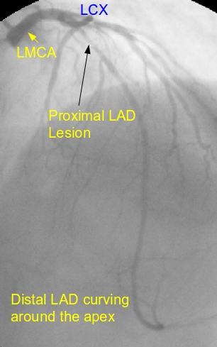 Type III LAD (Wraparound LAD) with proximal lesion