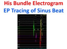 His Bundle Electrogram EP Tracing of Sinus Beat
