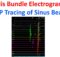 His Bundle Electrogram EP Tracing of Sinus Beat