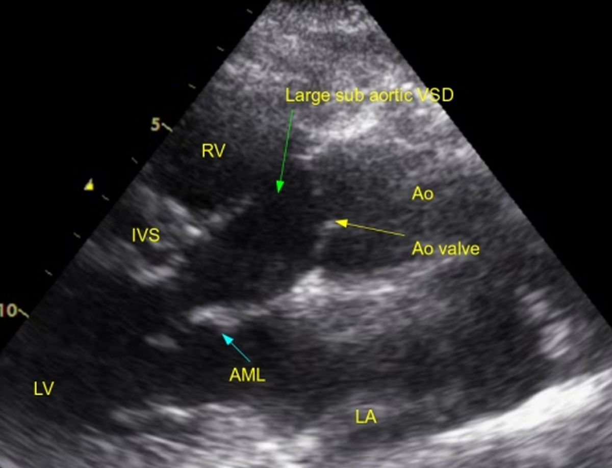 Subaortic VSD with aortic override