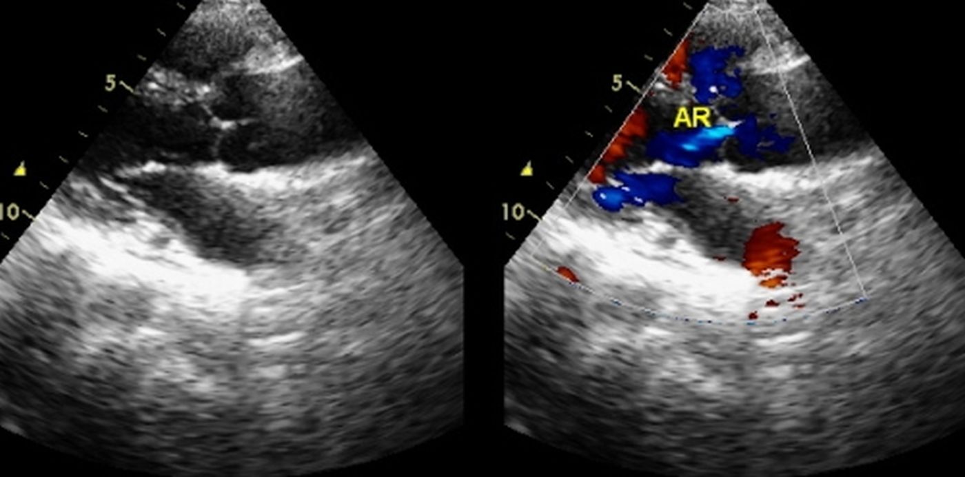 Trivial aortic regurgitation - echocardiogram